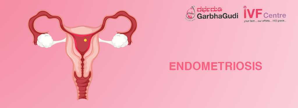 Endometriosis: Symptoms, Causes & Treatment Options