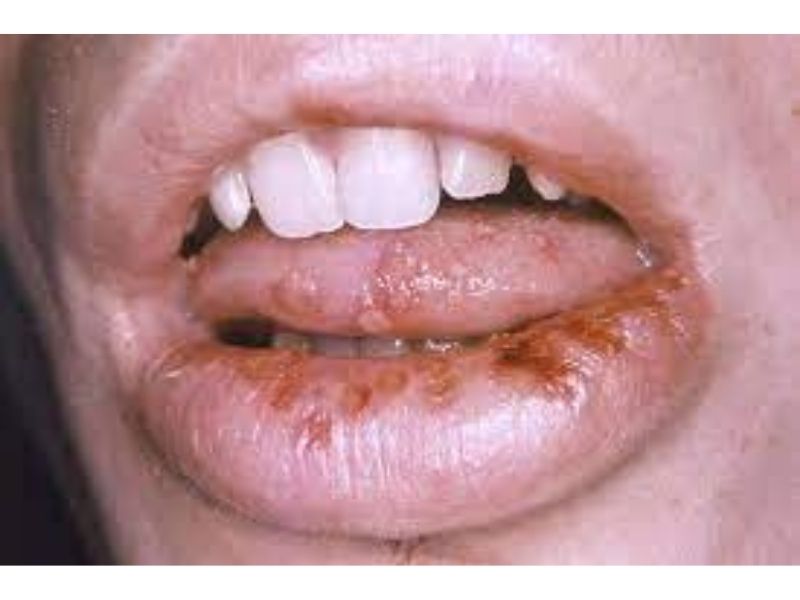 gonorrhea-on-mouth