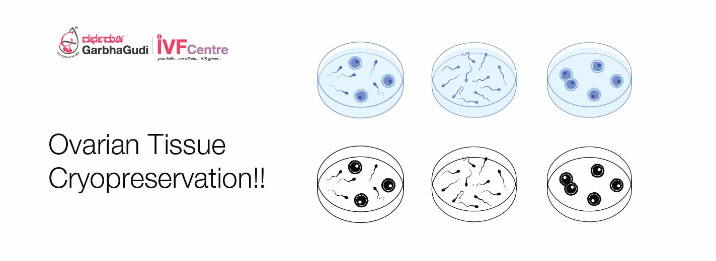 Ovarian Tissue Cryopreservation