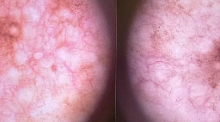 dermatoscopia-fig3-min.jpg