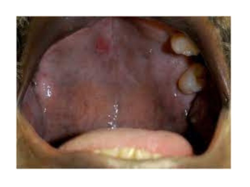 std tongue bumps