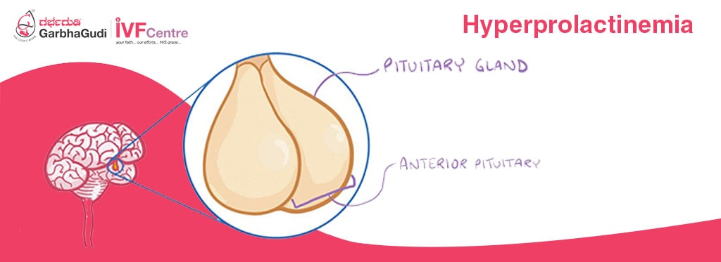 Hyperprolactinemia