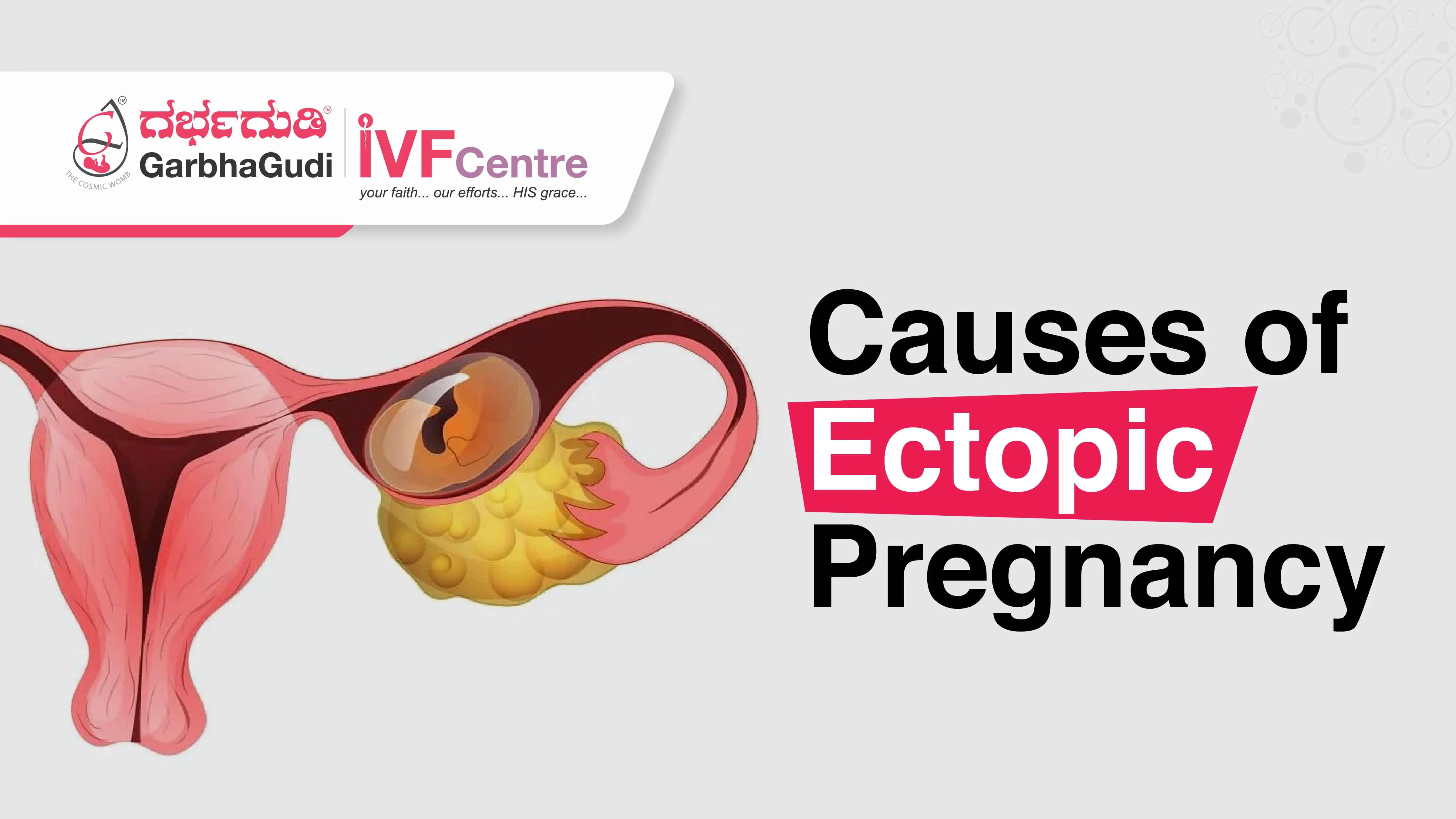 Causes of Ectopic Pregnancy