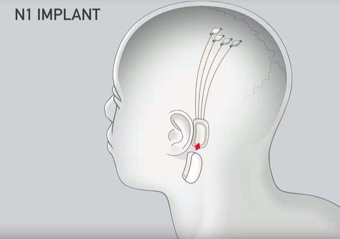 Neuralink 