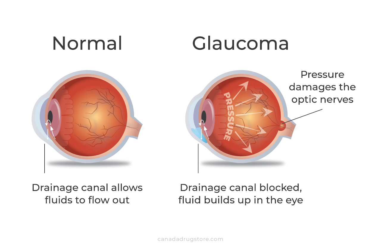glaucoma jcd.png