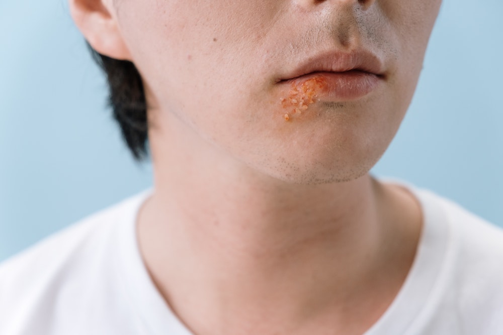 man-with-herpes-coldsores