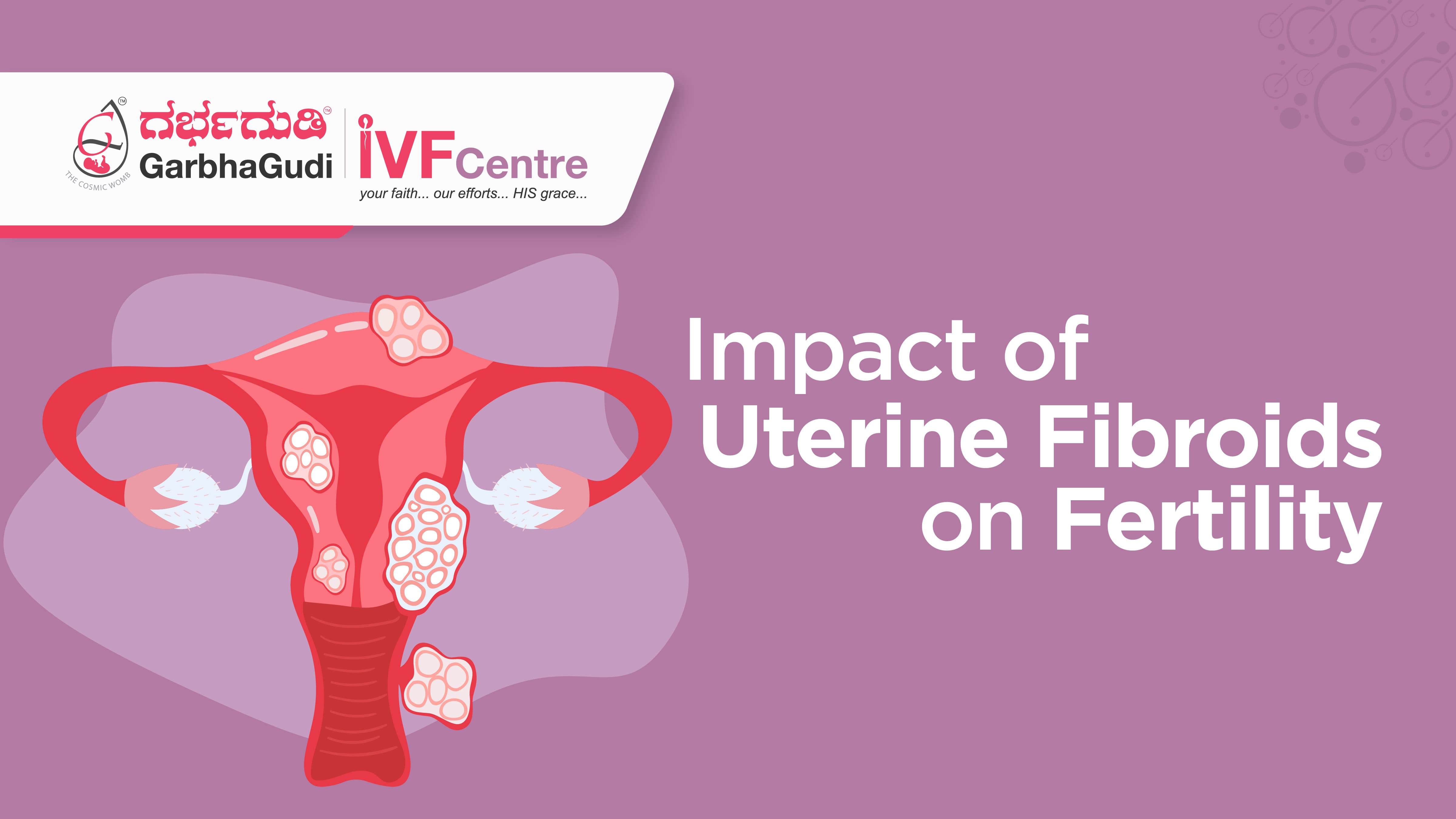 The Impact of Uterine Fibroids on Fertility