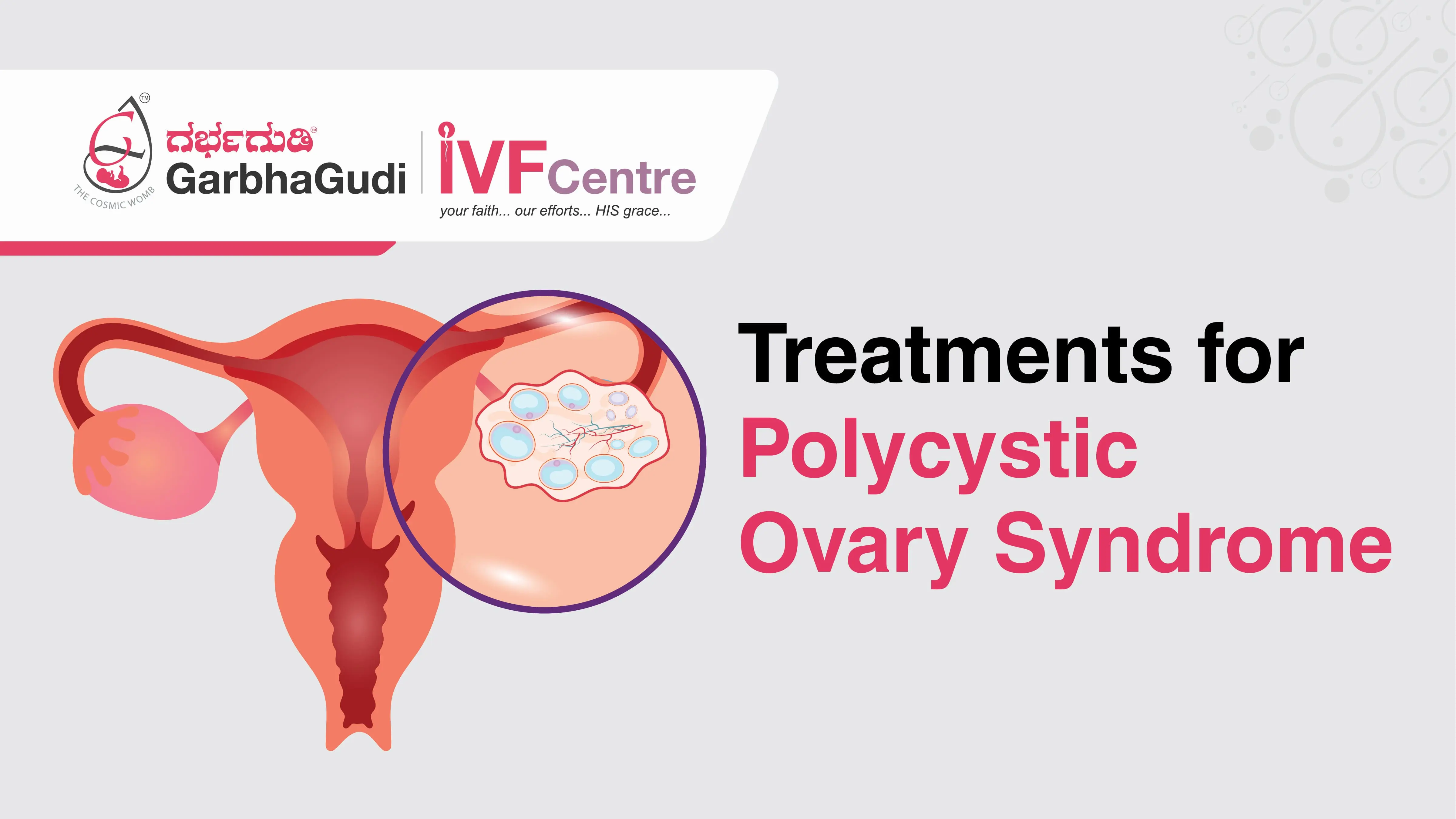 Treatments for Polycystic Ovary Syndrome