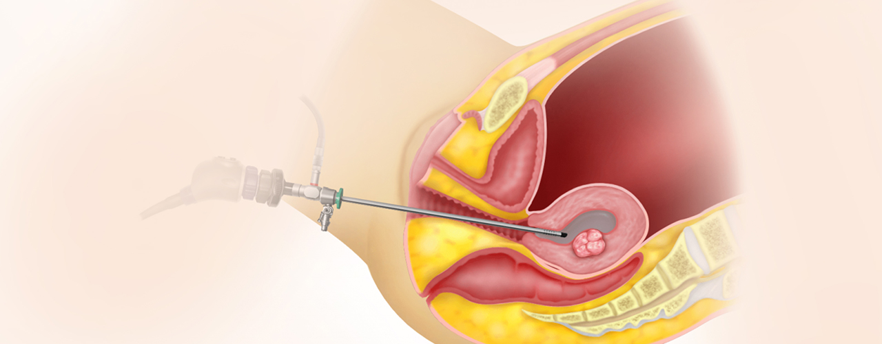 Hysteroscopy Treatment in Bangalore