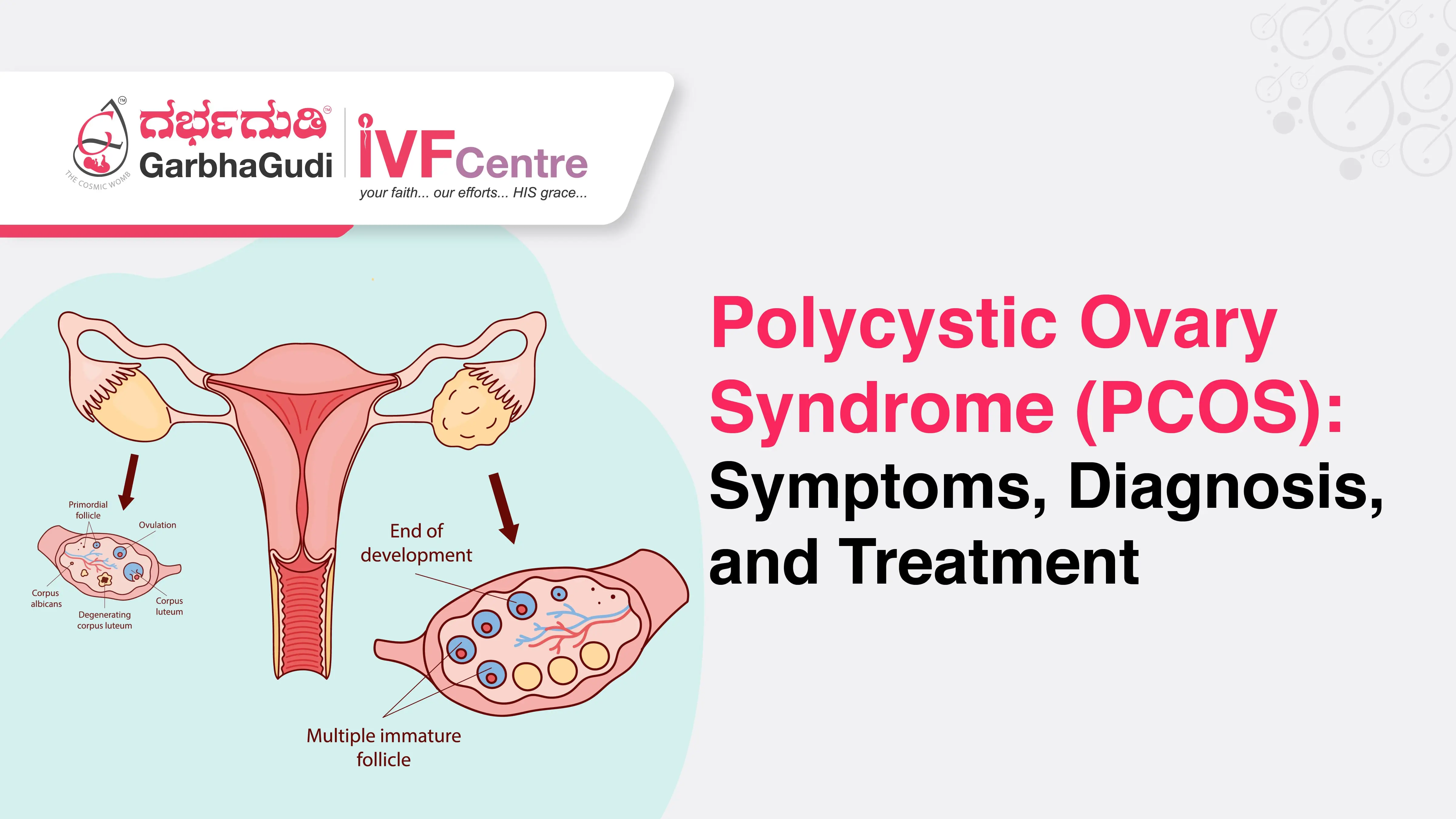 Polycystic Ovary Syndrome (PCOS): Symptoms, Diagnosis, and Treatment