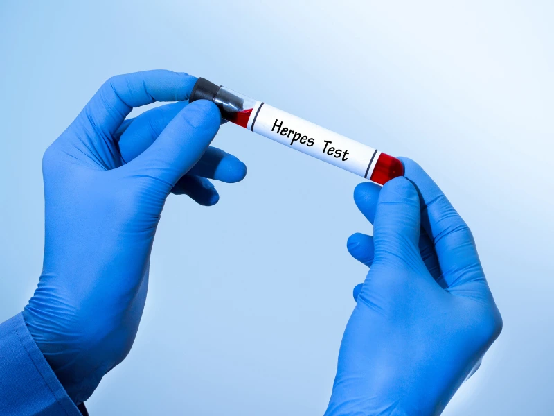Herpes can be tested at home