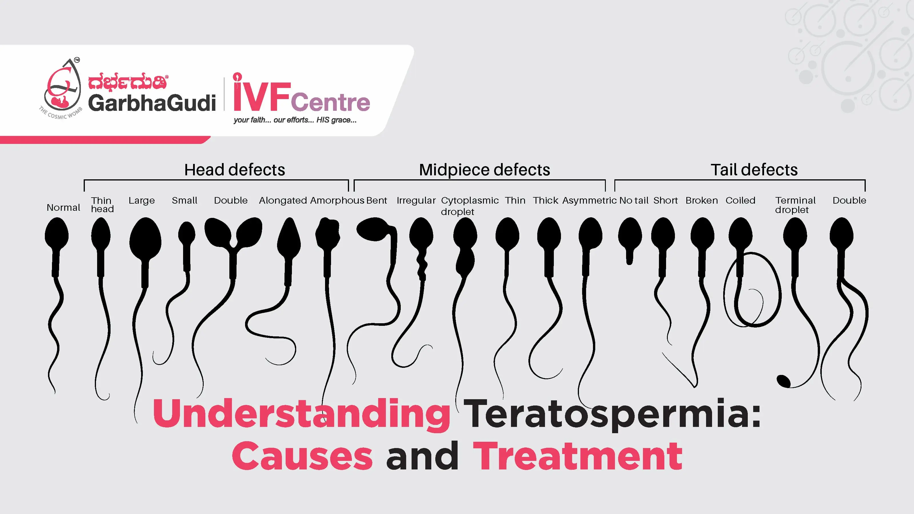 Understanding Teratospermia: Causes and Treatment