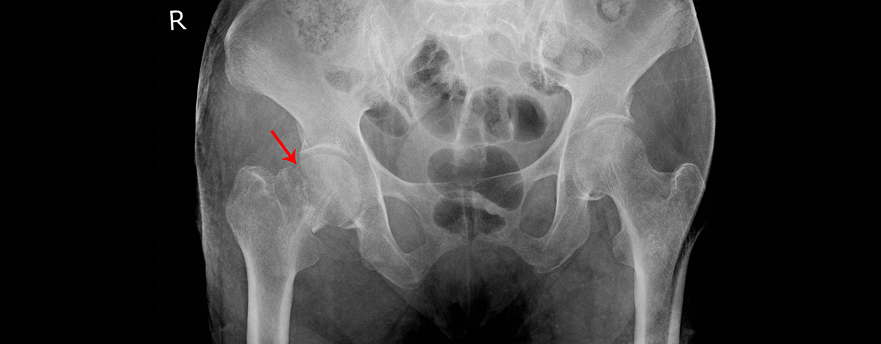 Pelvic Inflamatory Disease