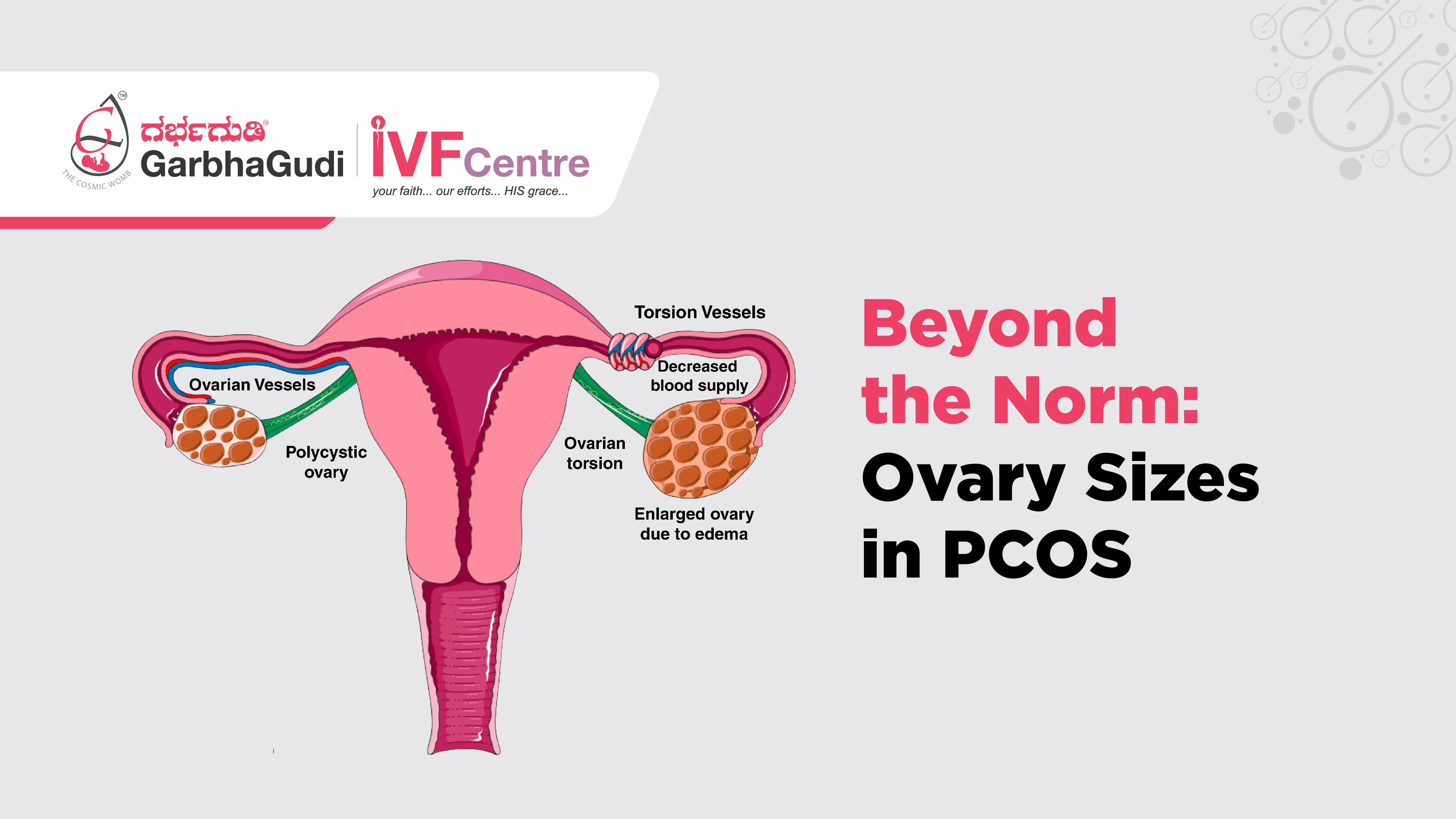 Beyond the Norm: Ovary Sizes in PCOS