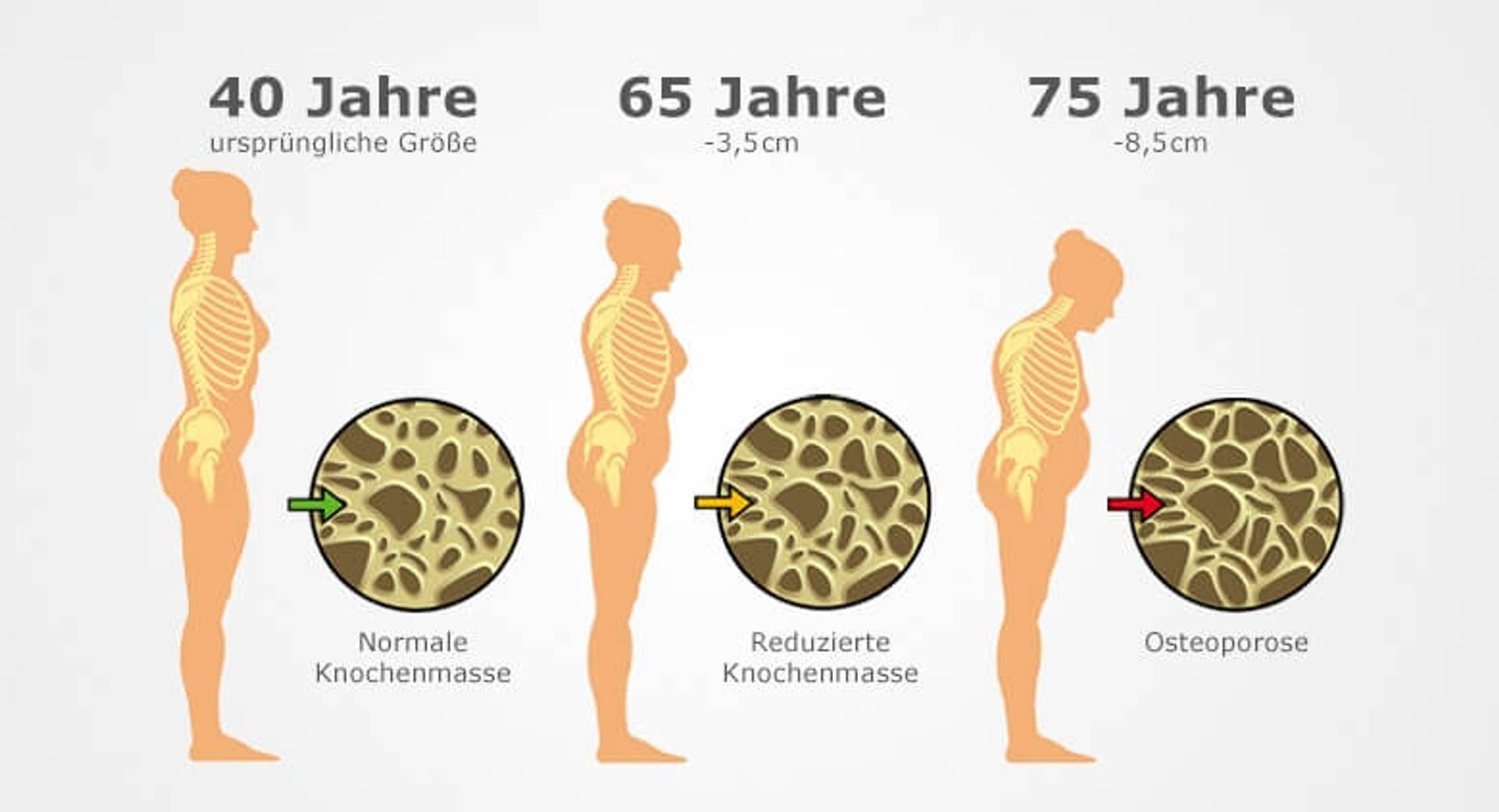 Wunderschne Vorstufe Der Osteoporose Bild