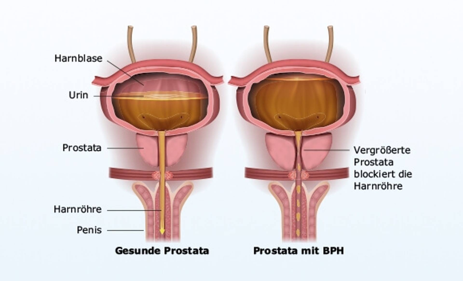 Prostata.jpg