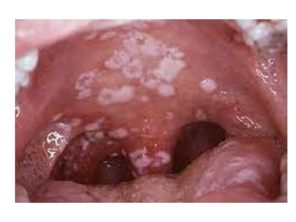 what does chlamydia look like in the mouth