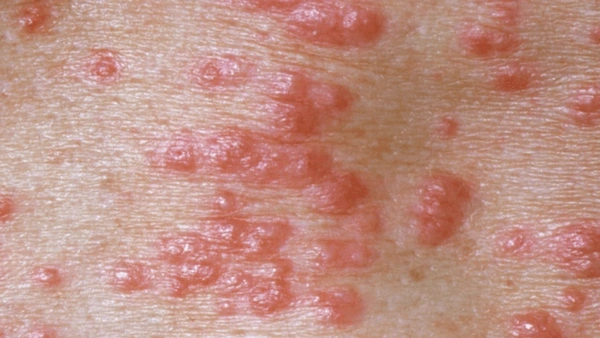 What's This Rash? Photos Of STIs, 43% OFF