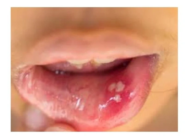 what does chlamydia look like in the mouth