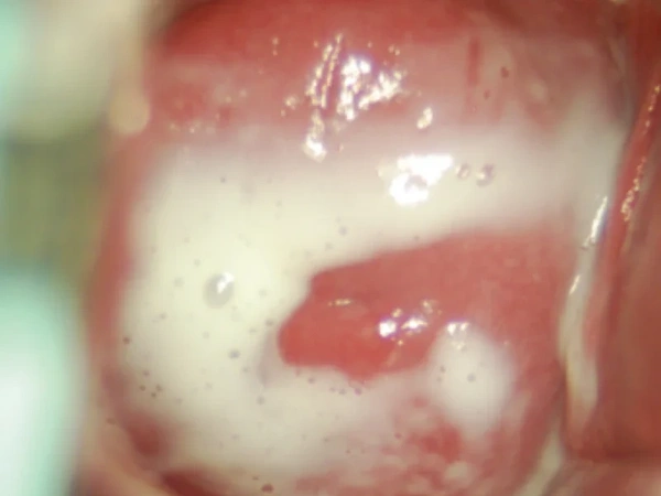 trichomoniasis discharge vaginal