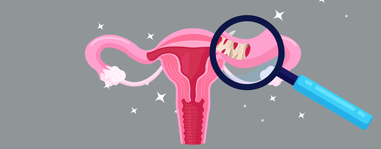 Blocked Fallopian Tubes