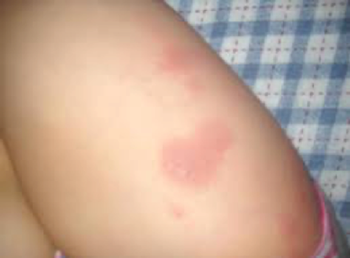 RTEmagicC_Alergijska-koprivnica.png.png RTEmagicC_Alergijska-koprivnica.png.png