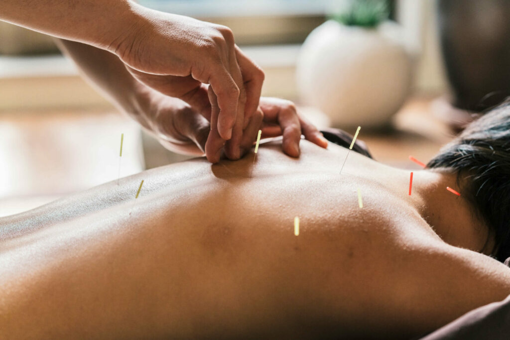 Man receiving acupuncture treatment