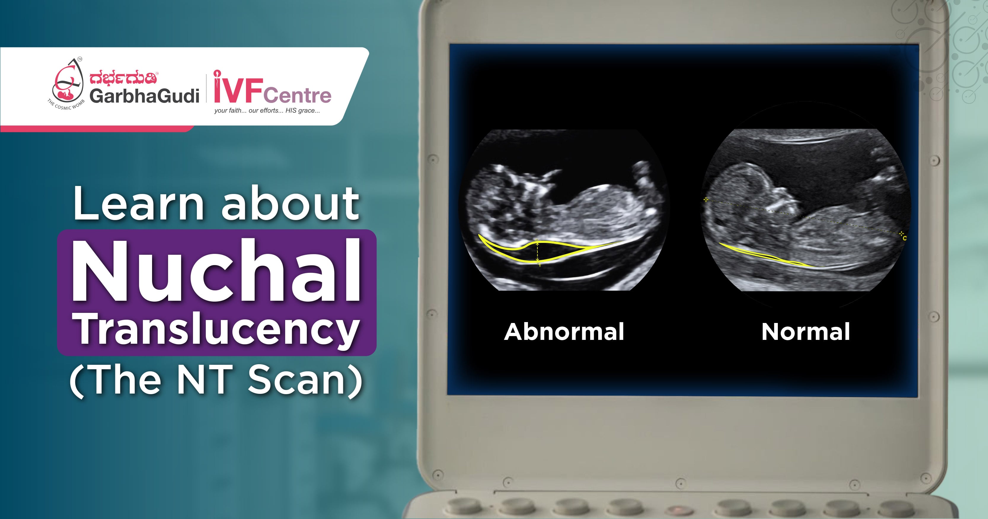 Learn About Nuchal Translucency The Nt Scan 