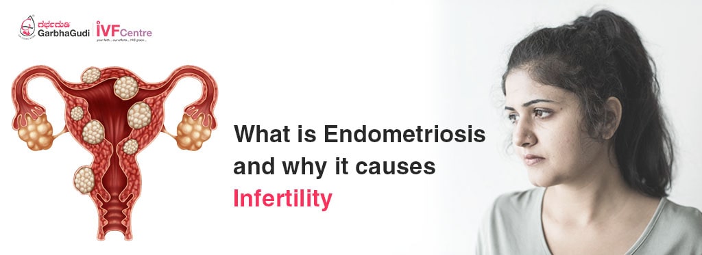 What is Endometriosis and why it causes infertility