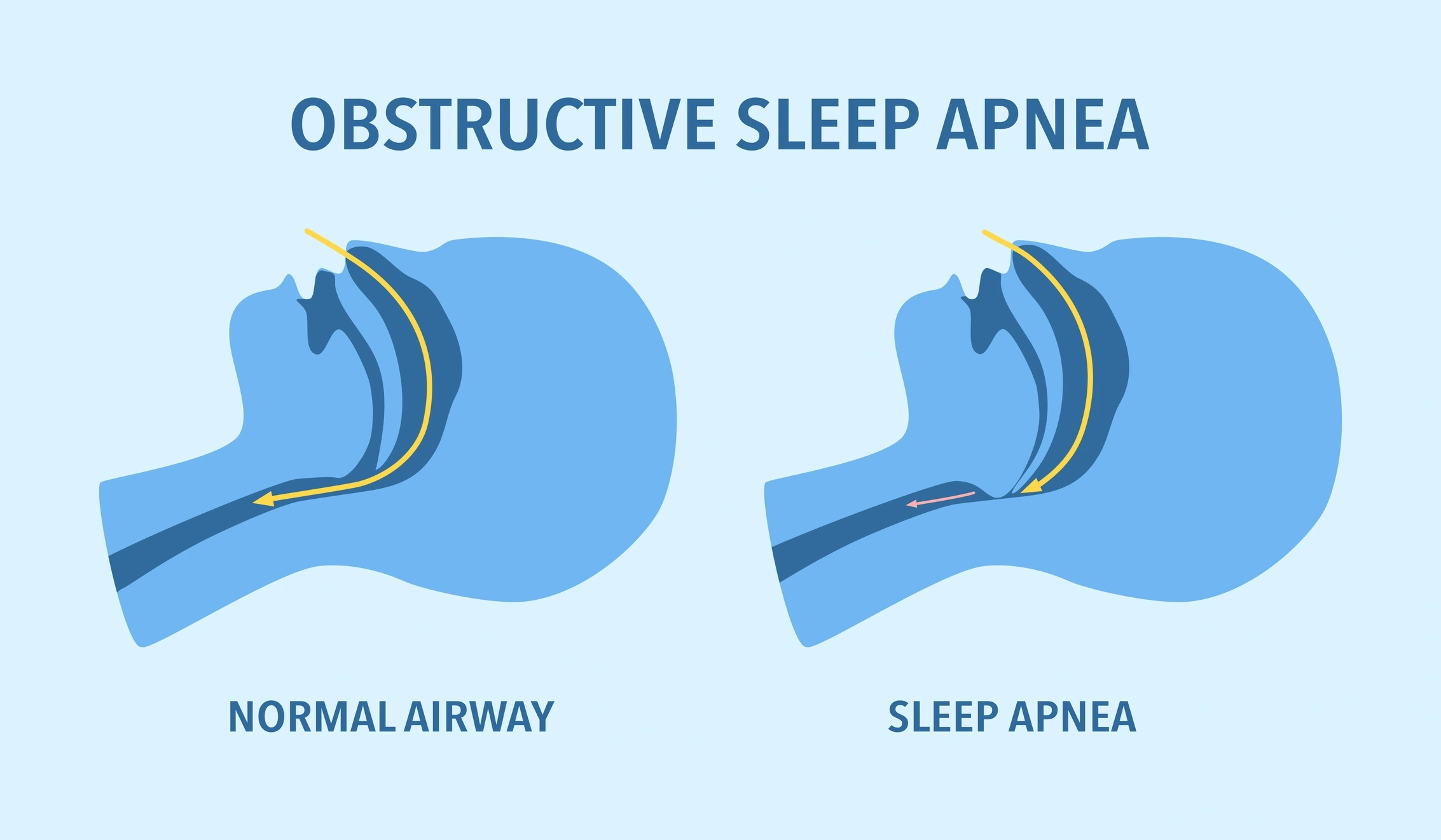 obstructive sleep apnoea.jpg