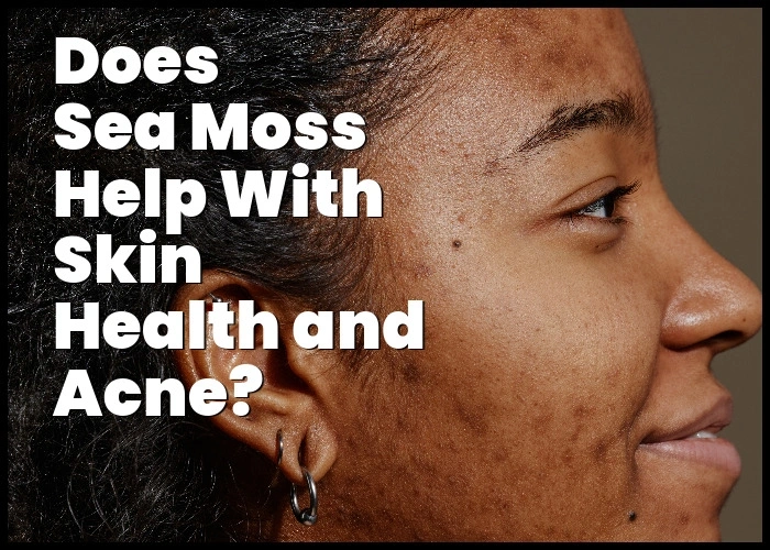 Does sea moss help with acne?