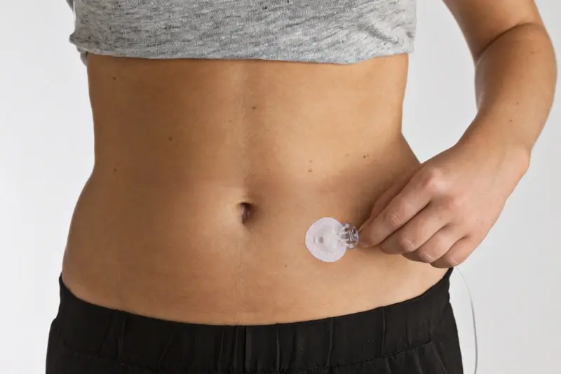 Infusion device attached to stomach 