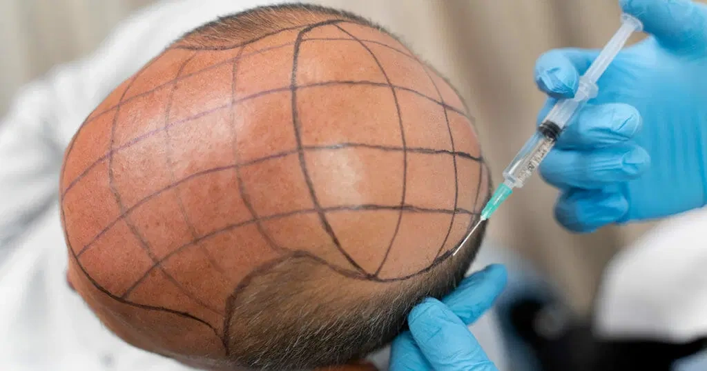 Is a hair transplant permanent?