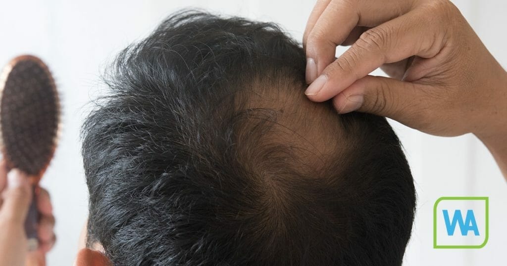 Who can benefit from a hair transplant procedure?