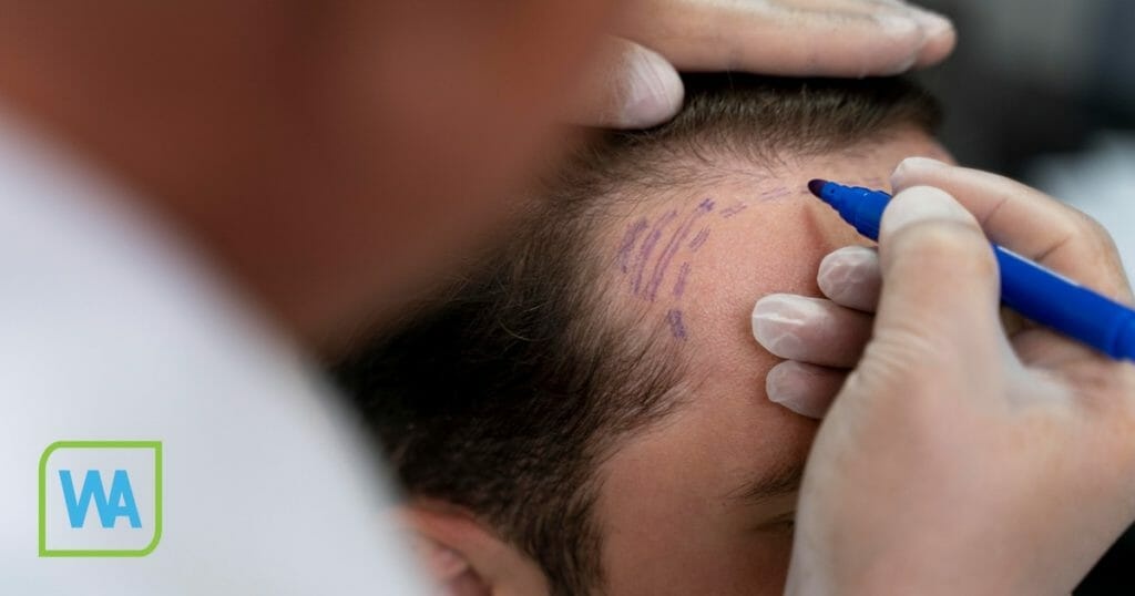 More about hair transplants