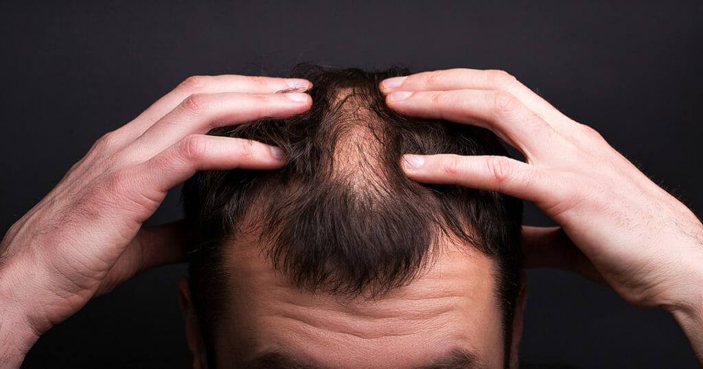 Hair Transplant Side Effects 