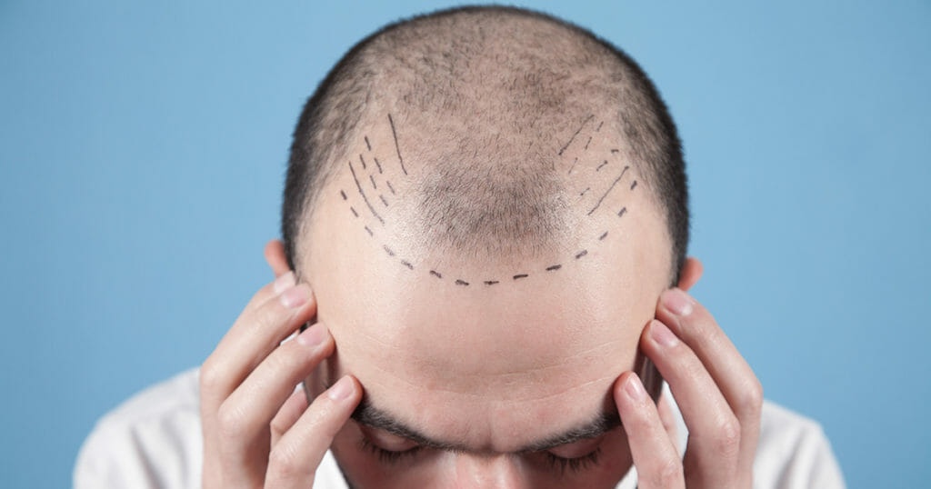 Hair Transplant Side Effects 