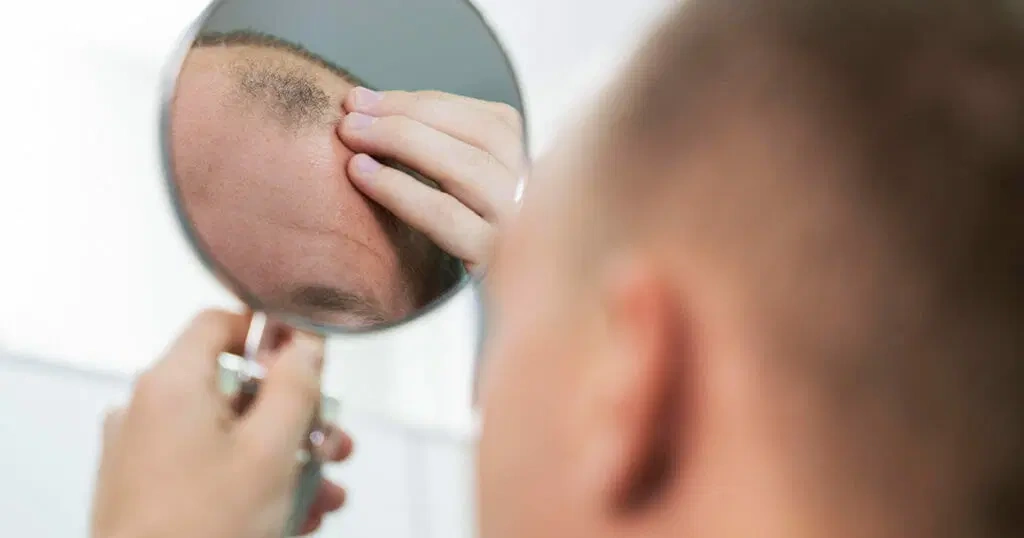 How Long Do Hair Transplants Last? - Welfare Abroad