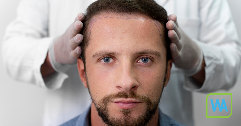 What is a hair transplant, and how does it work?