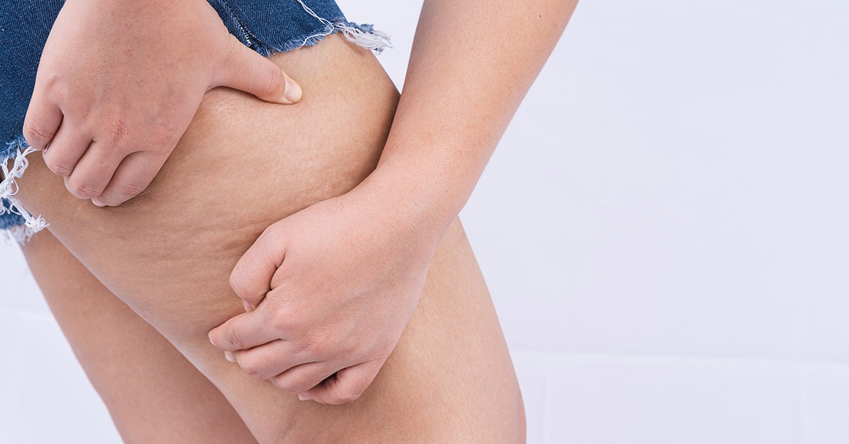 Cellulite Or Lipedema: Which Do I Have? What's The Best Treatment?