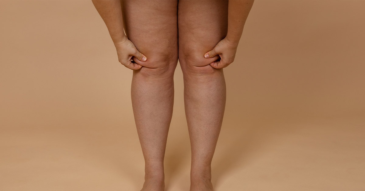 A Journey of Hope and Healing: Living with Lipedema