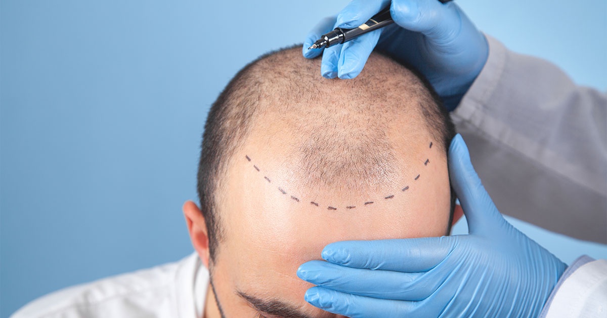 How much is a hair transplant?