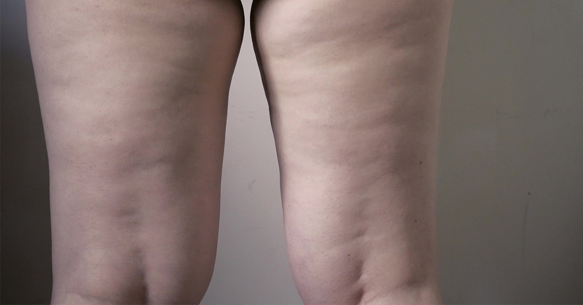 Lipedema Vaser Liposuction