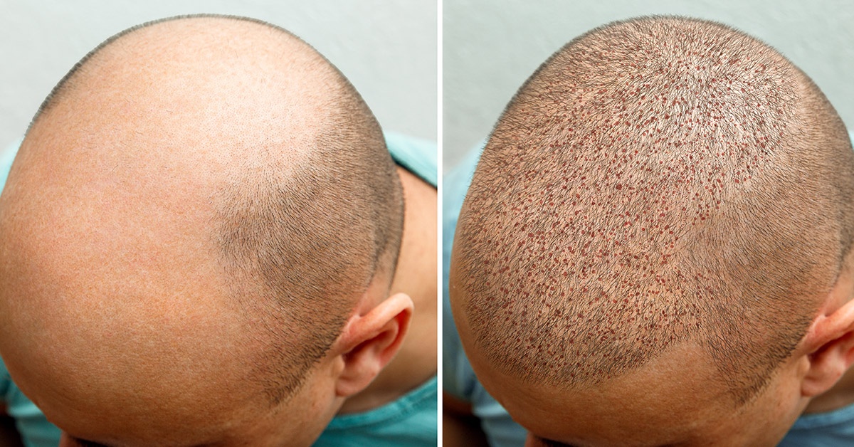Hair Transplant Recovery Process