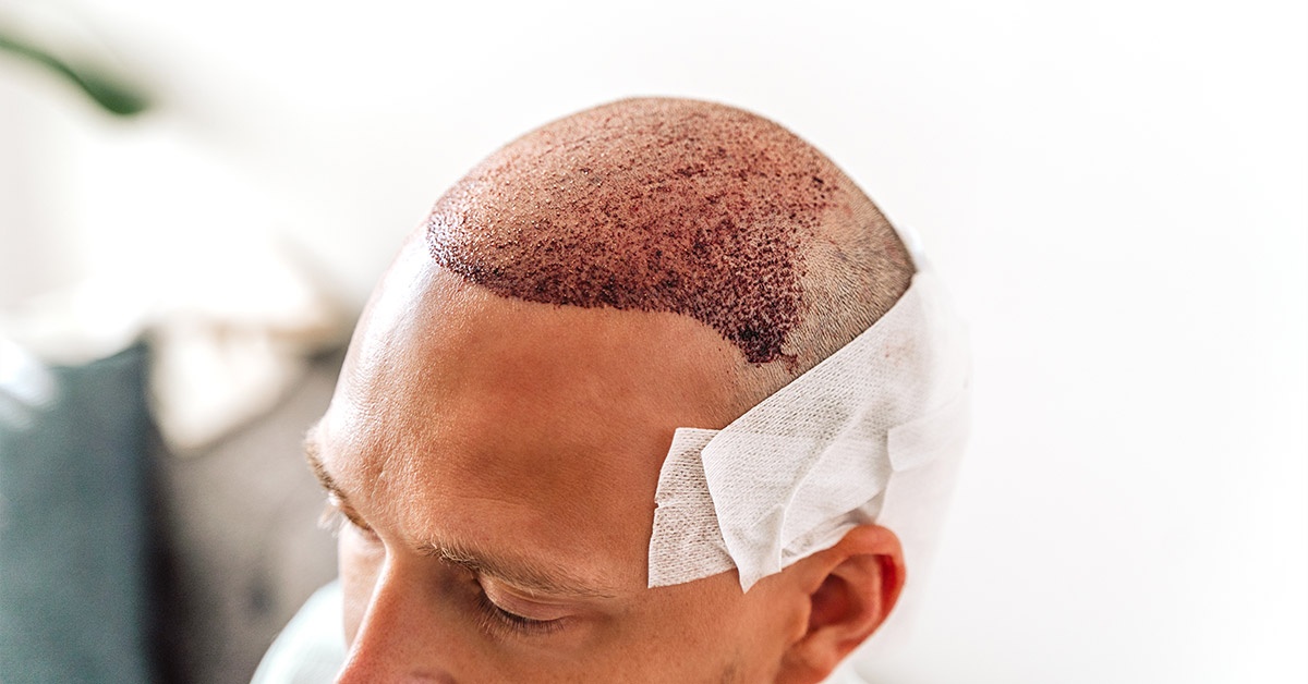 Does Hair Transplant Hurt?