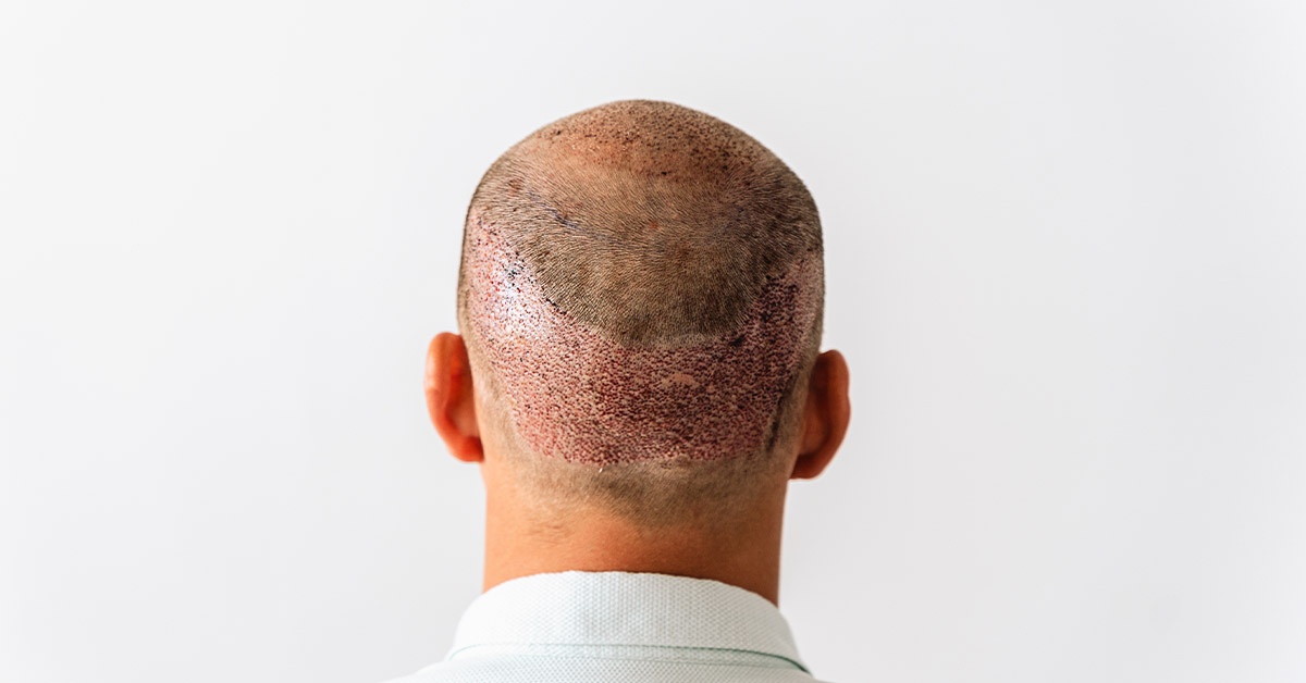 Does Hair Transplant Hurt?