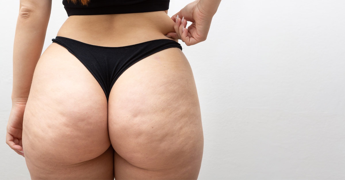 Differences in Lipedema and Cellulite: Causes & Treatments