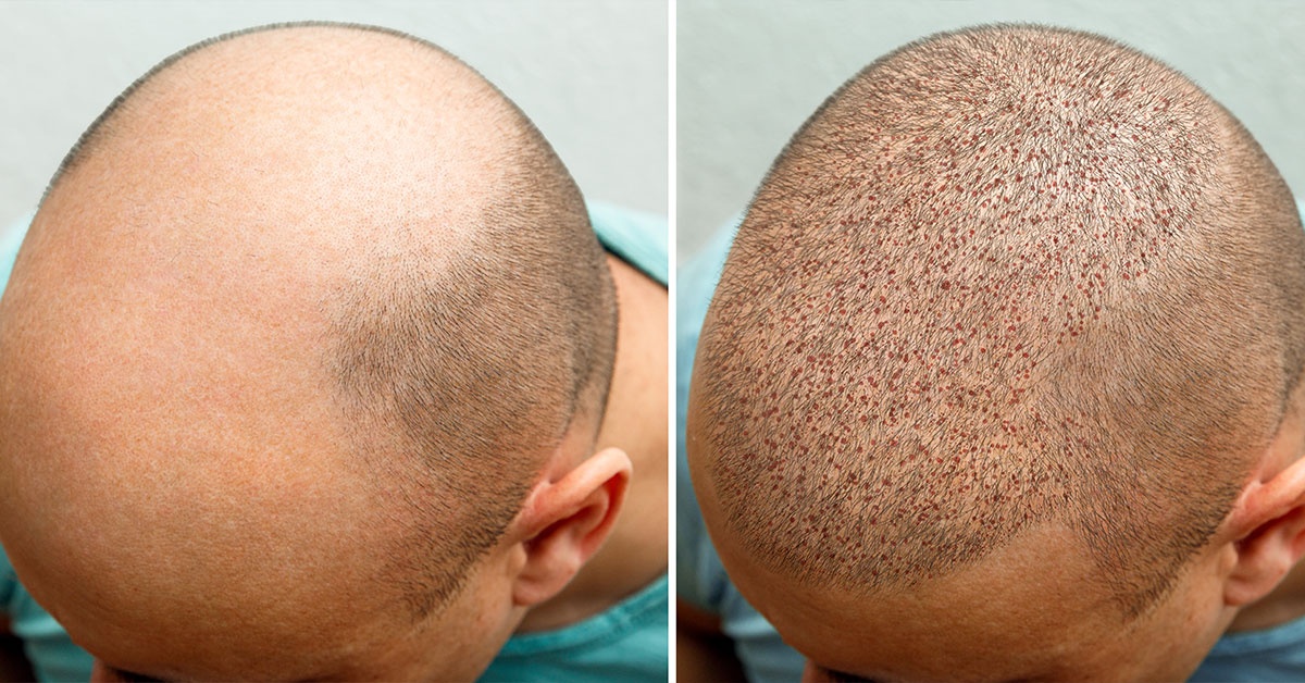 How much is a hair transplant?