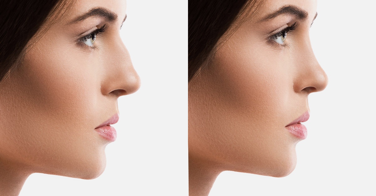 Septorhinoplasty