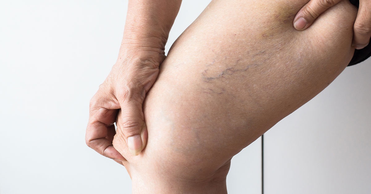 What Causes Varicose Veins And How to Treat Them